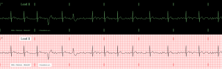 afib_polymorphic_pvc_combo.png