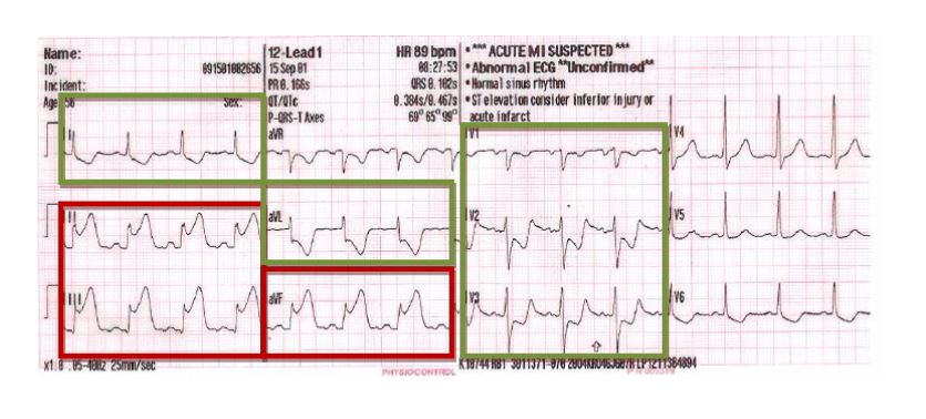 stemi.JPG