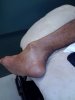 ankle dislocation-fibula fx.jpg