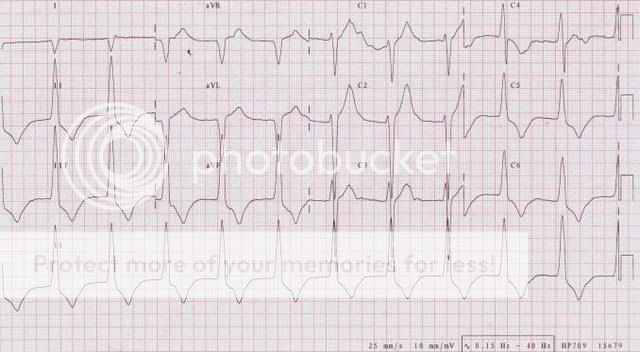 Accelerated20idioventricular20rhyth.jpg