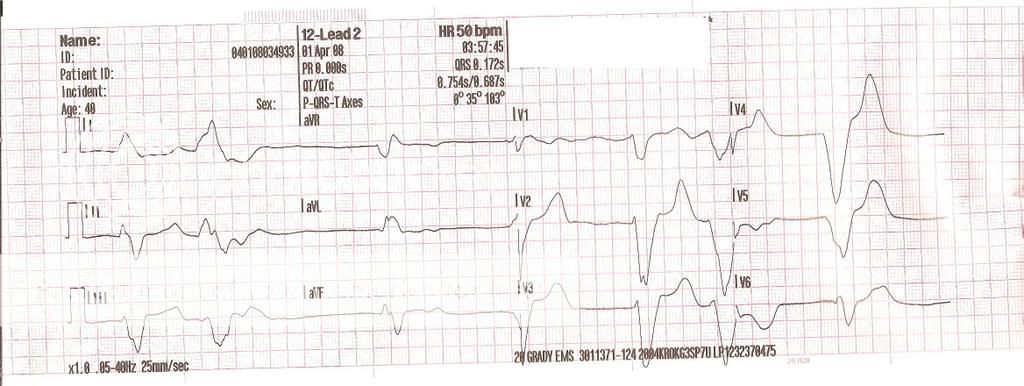 hypercalemia12lead2PBriggs41intrepr.jpg