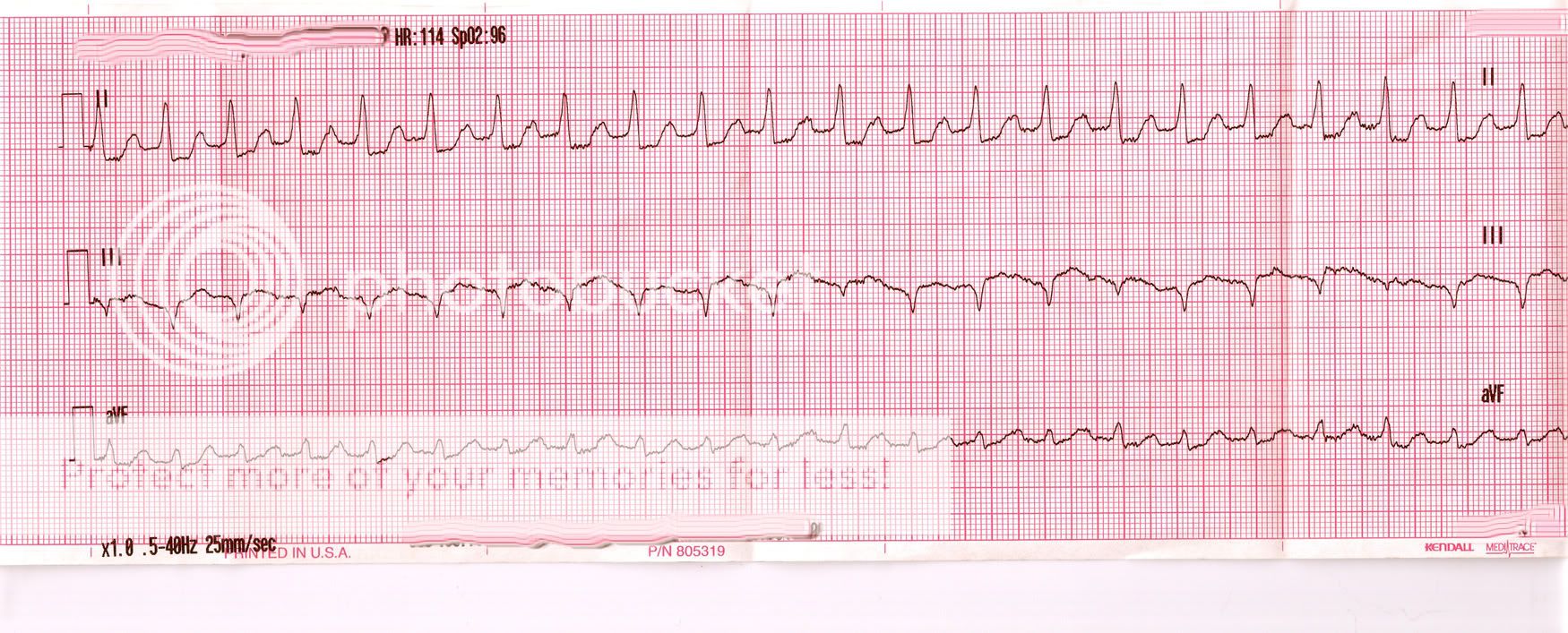 EKG1.jpg