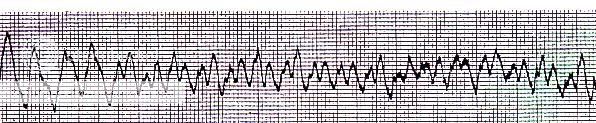 ventricularfibrillatio02.jpg