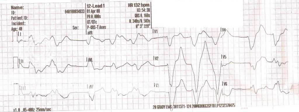 hypercalemia12lead1PBriggs41intrepr.jpg