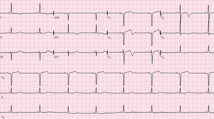 Wellens%27_Syndrome.png