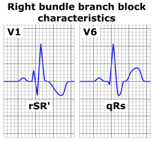 Right_bundle_branch_block_ECG_characteristics.png